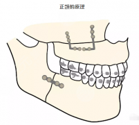 北京正颌手术可以医保报销吗？地包天术前必看攻略！