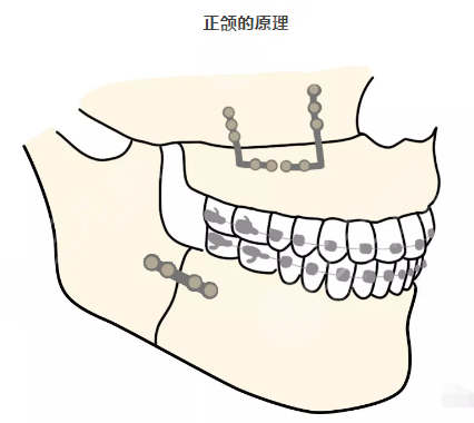 北京正颌手术可以报销吗