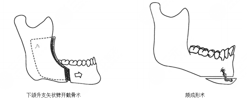 北京正颌手术可以报销吗