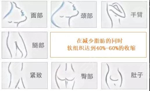 钻石吸脂术怎么样