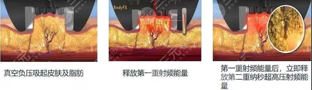 钻石吸脂恢复期多久