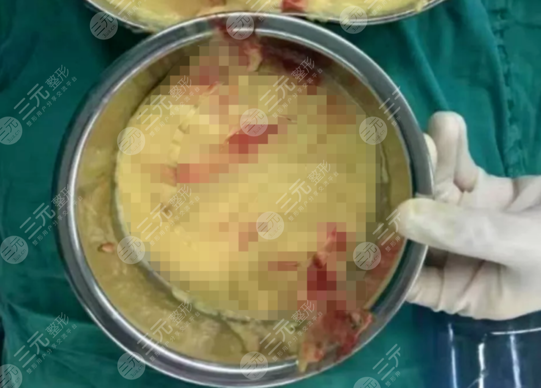 取奥美定用什么技术有