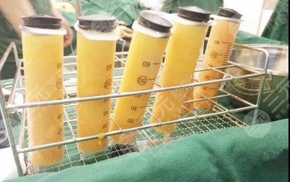 目前良好的吸脂方式