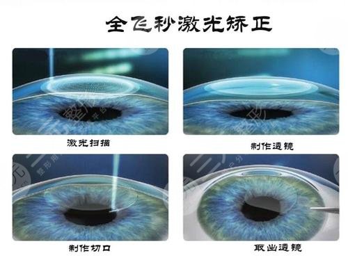 郑州近视激光手术价格
