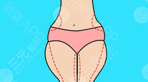 国内抽脂手术成熟吗