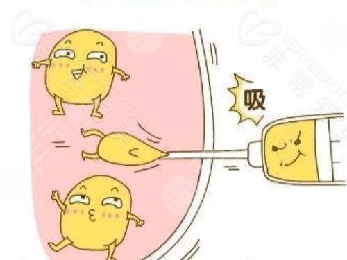 国内抽脂手术成熟吗