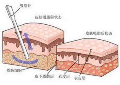 溶脂的作用与功