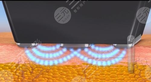 钻石超塑爆脂费用