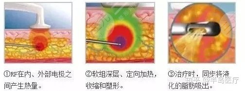 钻石微雕原理