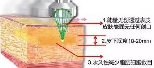 超脂塑的费用是多少呢