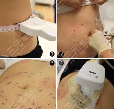 超脂塑的费用是多少呢