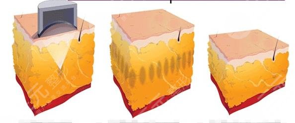 超脂塑溶脂手术适应症有哪些