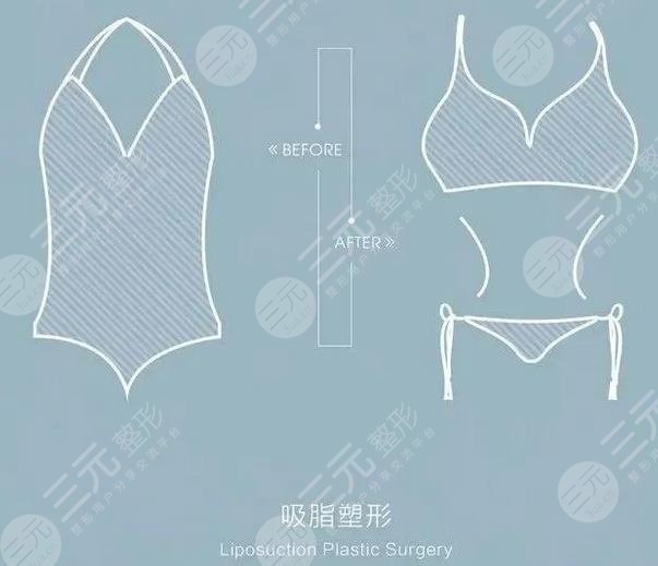 网络疯传的超脂塑吸脂到底啥来头
