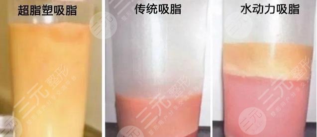 与普通吸脂有什么区别