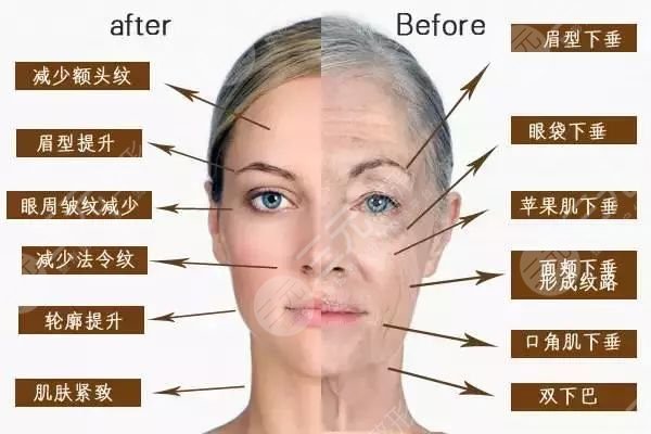 聚拉提7D做一次多少钱？本文来解答一下影响聚拉提7D价格的原因...