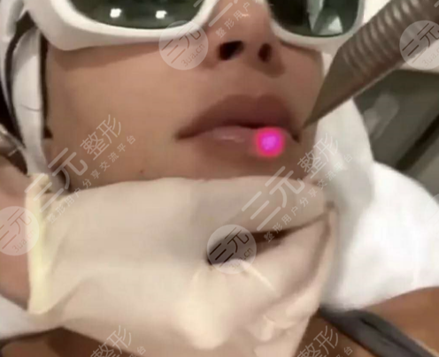 欧洲之星4d和热玛吉区别