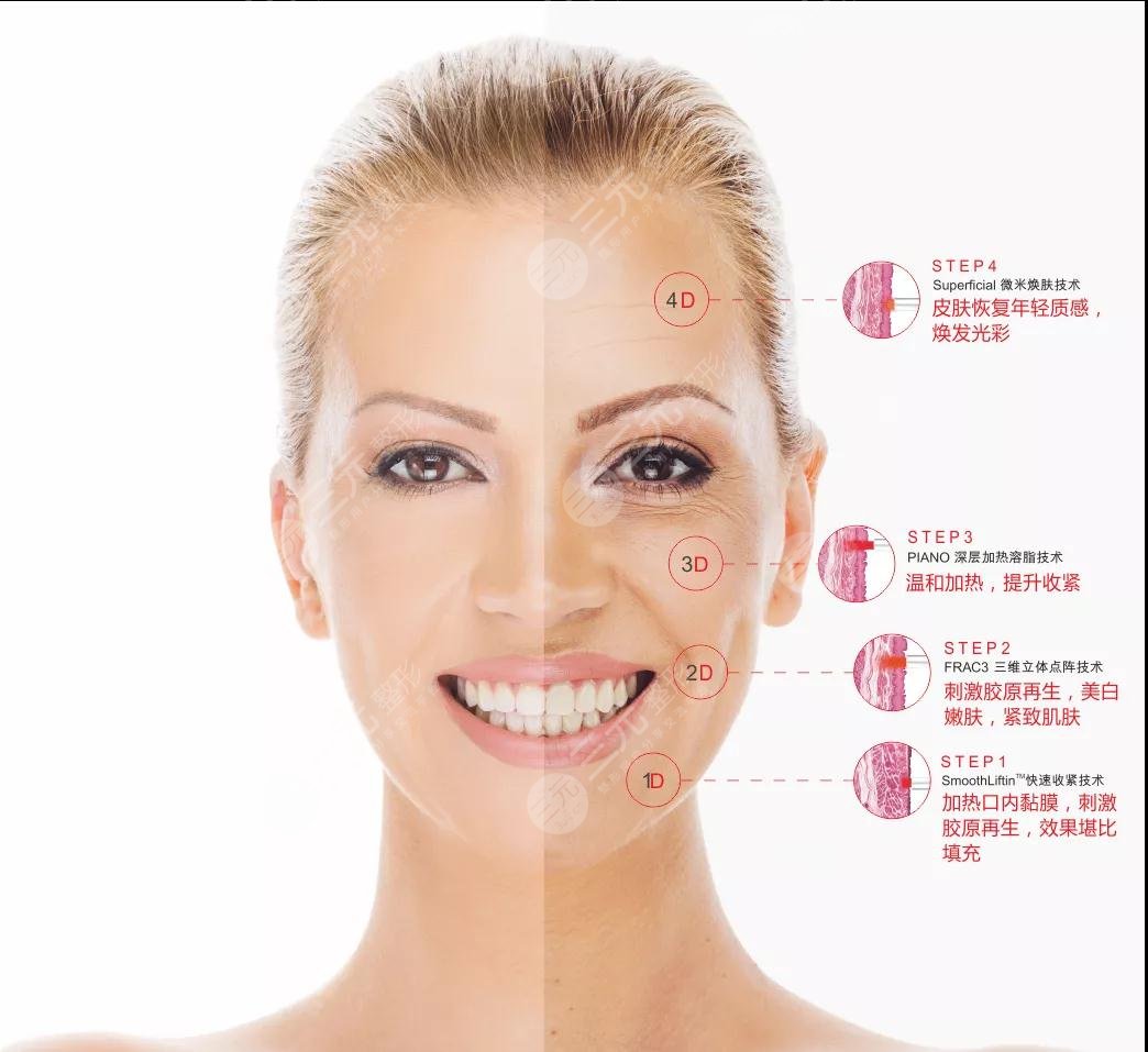 欧洲之星4d和热玛吉区别