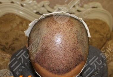 广州倍生植发医院大面积加密种植案例分享