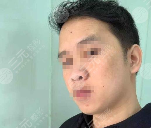 合肥新生植发医院大面积植发案例分享