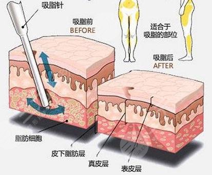 钻石吸脂价格