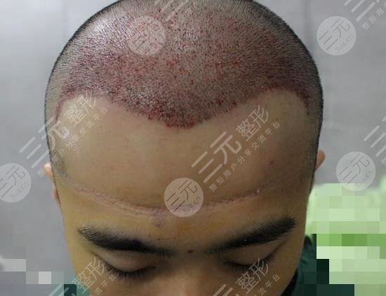 广州新生植发医院发际线移植案例分享