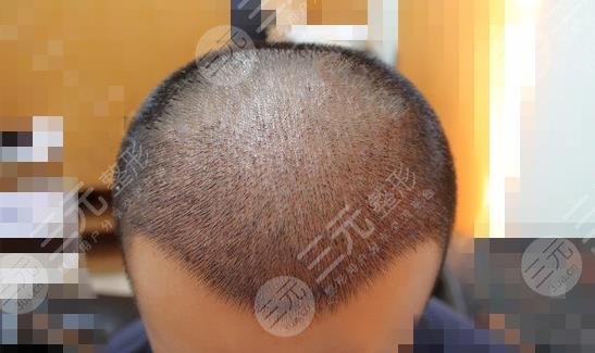 广州新生植发医院发际线移植案例分享