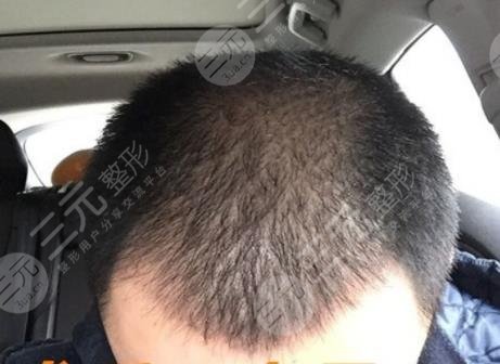 广州雍和植发医院秃顶植发案例分享