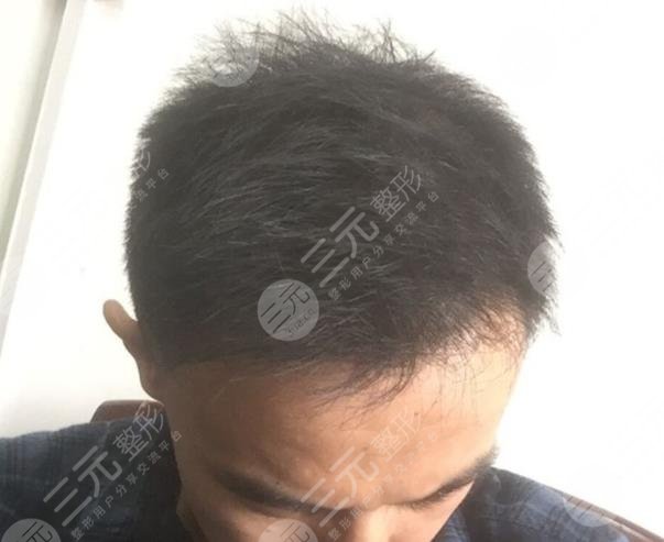 广州雍和植发医院秃顶植发案例分享