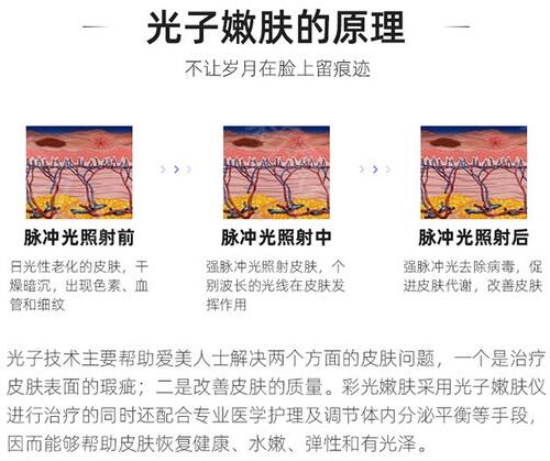 光子嫩肤