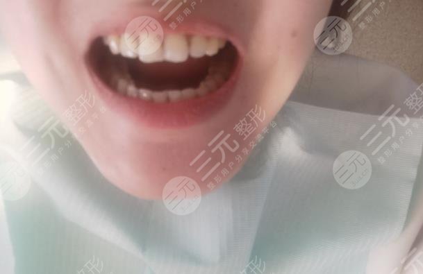 北京口腔医院种植牙案例