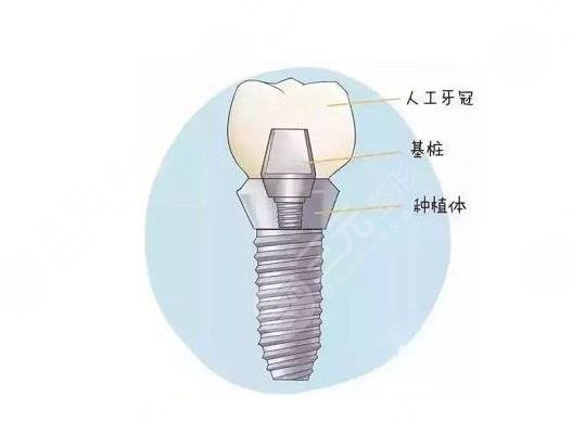 北京口腔医院种植牙术前注意事项