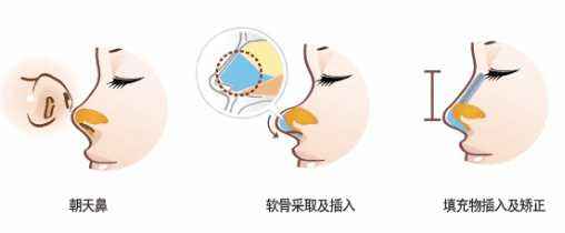 国内隆鼻