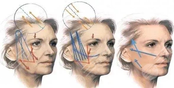 面部抗衰抗皱知识科普