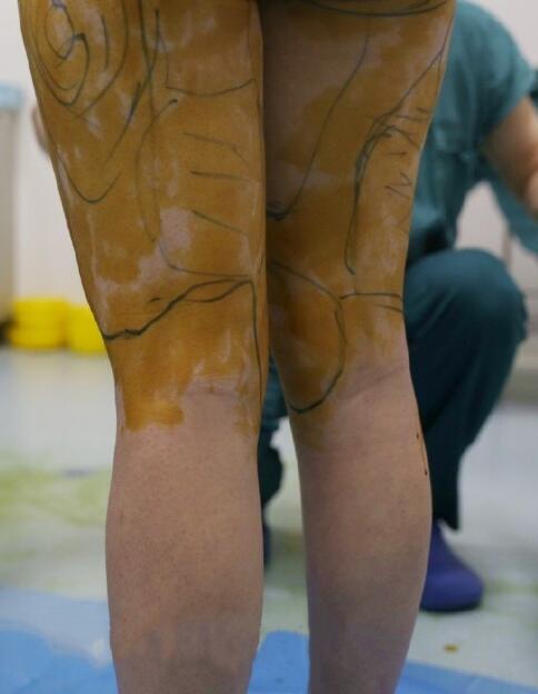 国内吸脂医院:北京禾美嘉大腿吸脂案例