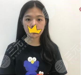 上海喜美曲妙轩双眼皮术前