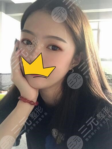 全切双眼皮术当天