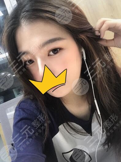 全切双眼皮术后果