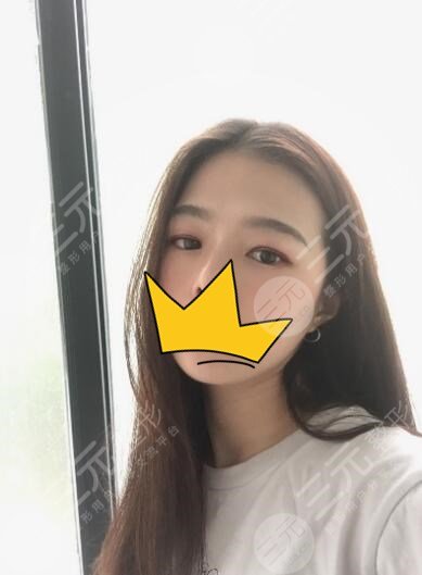 全切双眼皮术后90天