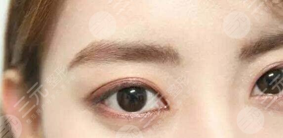 眼部手术的项目有哪些