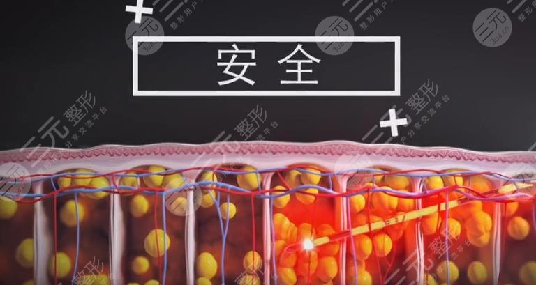 5g天使光雕一个部位多少钱