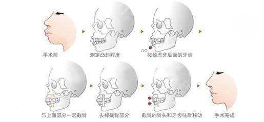 正颌手术