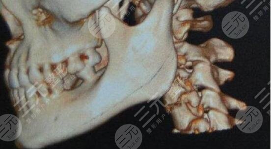 做磨骨手术的注意事项须知