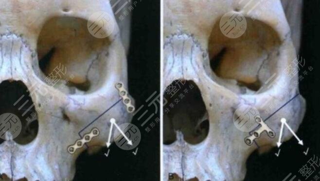 磨骨手术成好吗