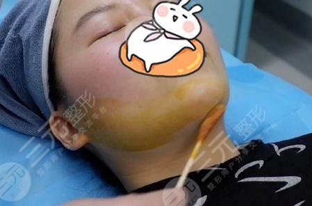 浙医一院整形外科激光溶脂瘦脸案例果图分享：溶脂前