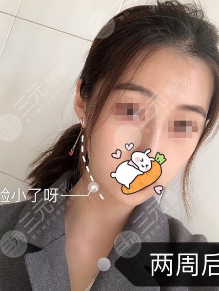浙医一院整形外科激光溶脂瘦脸案例果图分享：溶脂后
