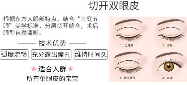上海帝妍迎采医疗美容科普全切双眼皮