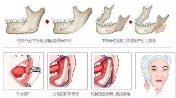 下颌角手术流程