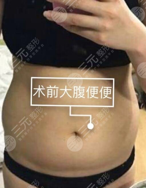 上海星璨陈飞春吸脂前