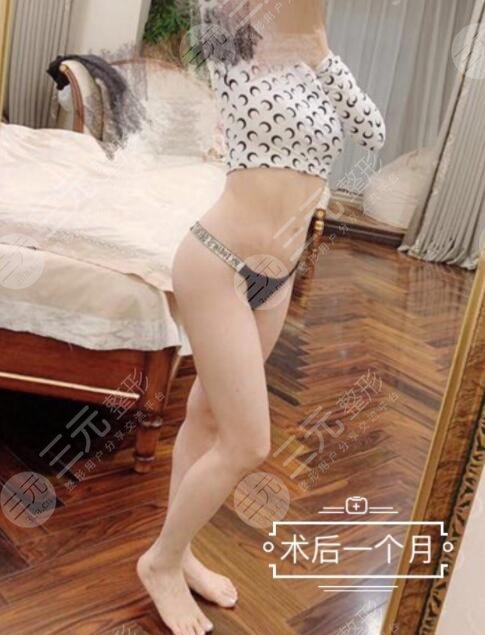 吸脂手术后一个月