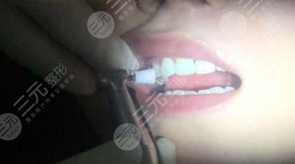 北京佳美口腔医院牙齿美白案例分享